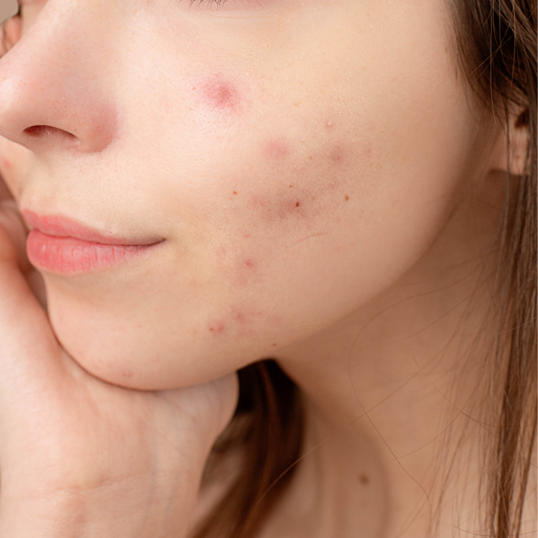 Acne Marks Treatment